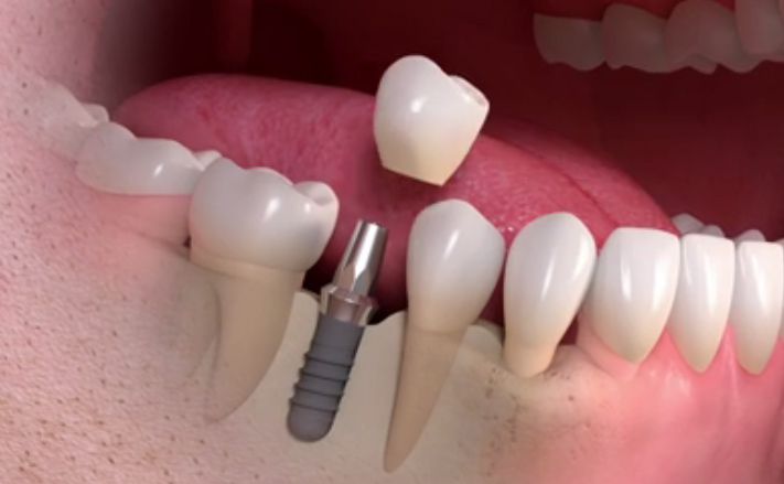 Dental implants offer a permanent solution to missing teeth : CM Dental Cinic Chiang Mai.