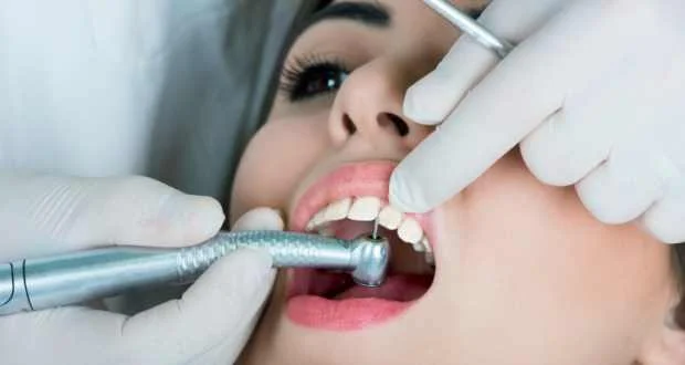 Dental Fillings, chiang mai clinic