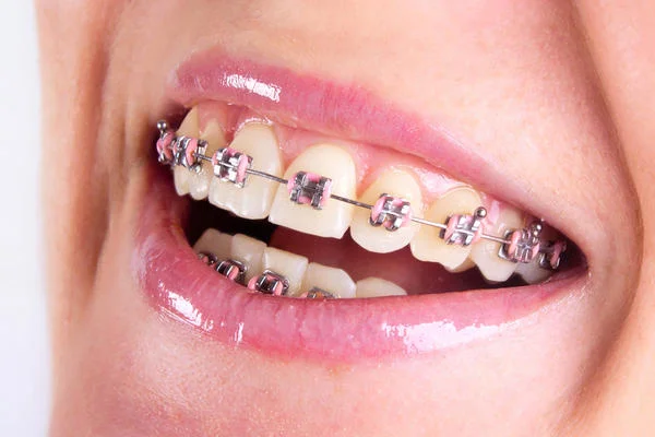 Orthodontics Treatment, chiang mai dentist