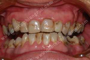 Dental Veneers Chiang Mai