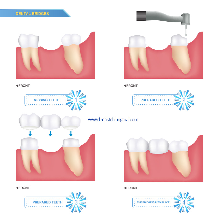 Dental Bridge Chiang Mai