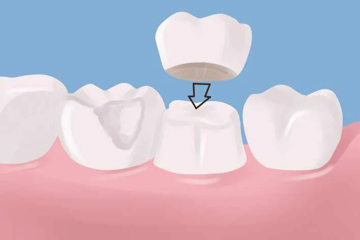 Dental Crown in dental chiang mai clinic, Thailand dental Crown, chiang mai