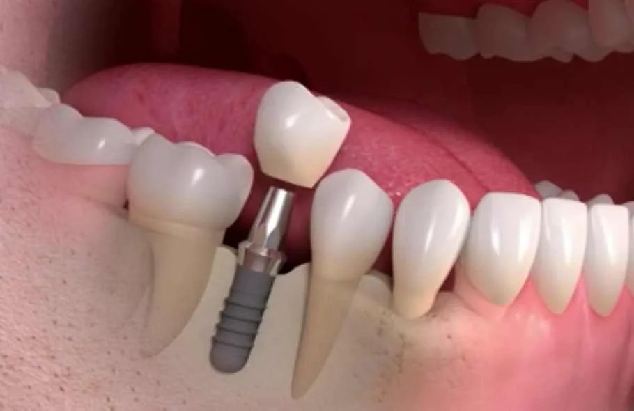 Dental implants in chiang mai clinic, Thailand. dental implants, chiang mai clinic