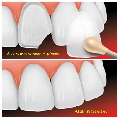 veneers Chiang Mai, Thailand Clinic dental Veneers, chiang mai