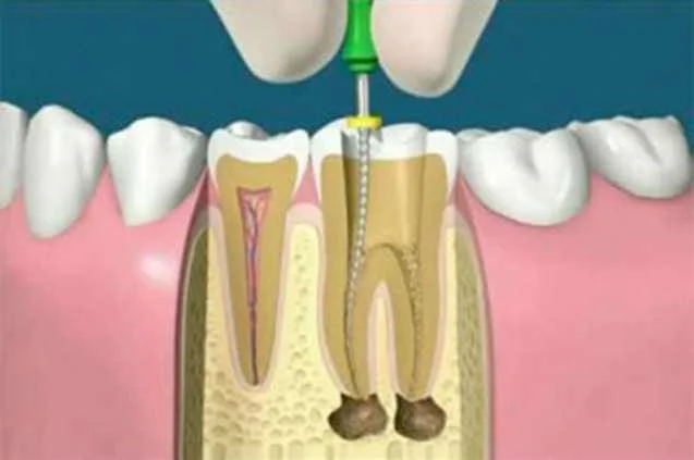 dental Root Canal Treatment, chiang mai