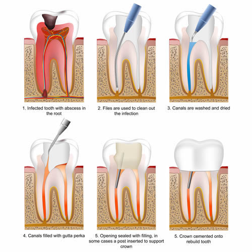 What Tools Are Used In Root Canals? - East Coast Endodontics