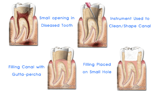 The Root Canal Treatment Procedure