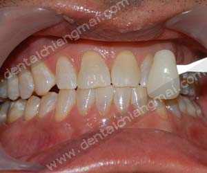 Teeth whitening treatments chiang mai