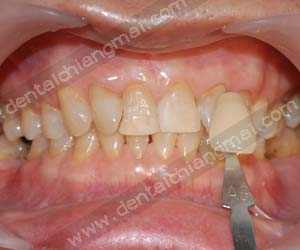 Teeth whitening treatments chiang mai clinic