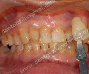 Teeth whitening treatments chiang mai clinic