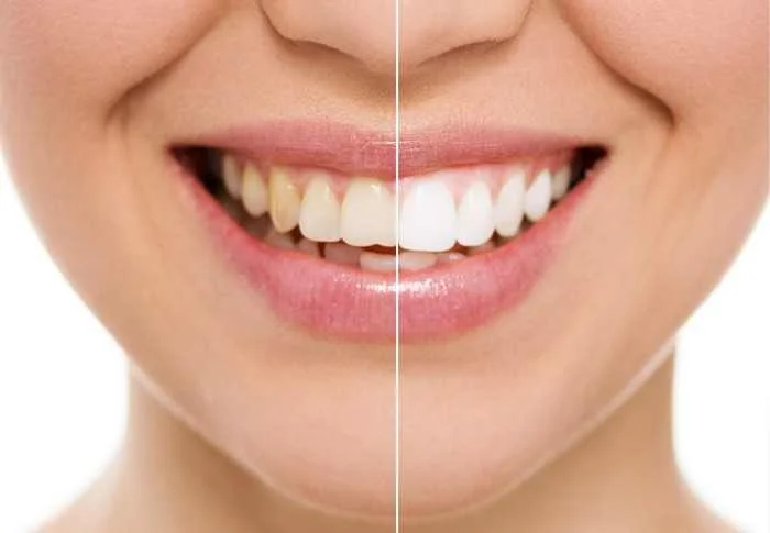 Teeth whitening at dental chiang mai clinic