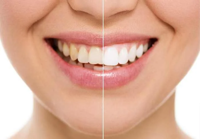 Teeth whitening at dental chiang mai clinic, Thailand. Teeth whitening at dental chiang mai clinic