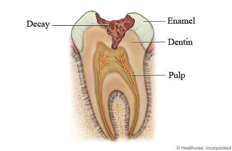 dental Inlays-Onlays, dental clinic in chiang mai